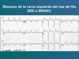 Bloqueo de la rama izquierda del haz de His
(BRI ó BRIHH)
 