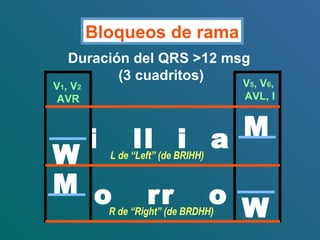 Bloqueos de rama
i ll i a
Duración del QRS >12 msg
(3 cuadritos)
L de “Left” (de BRIHH)
V5, V6,
AVL, I
R de “Right” (de BRDHH) W
o rr oM
M
W
V1, V2
AVR
 