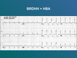 BRDHH + HBA
 