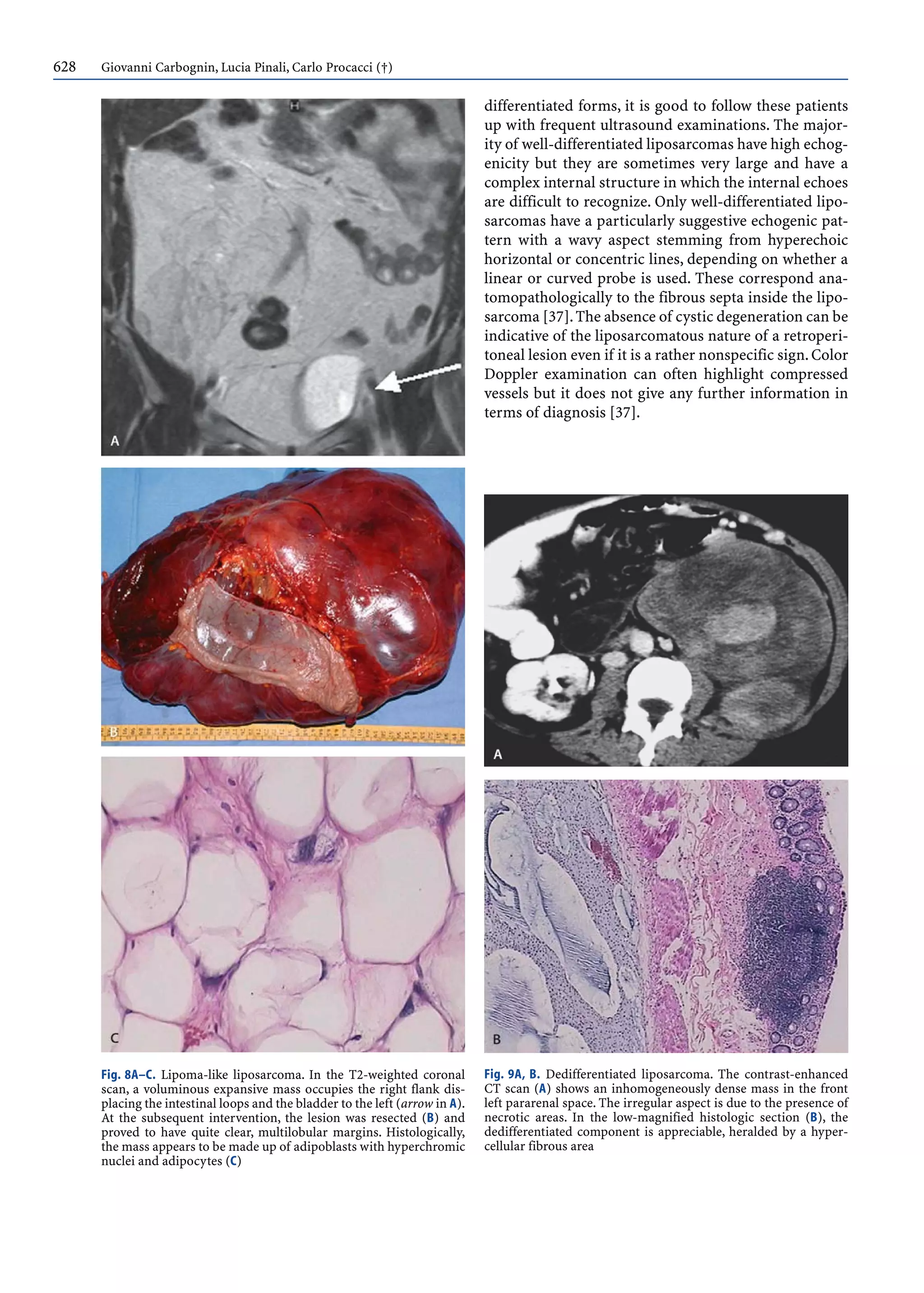 628 Giovanni Carbognin, Lucia Pinali, Carlo Procacci (†)
differentiated forms, it is good to follow these patients
up with frequent ultrasound examinations. The major-
ity of well-differentiated liposarcomas have high echog-
enicity but they are sometimes very large and have a
complex internal structure in which the internal echoes
are difficult to recognize. Only well-differentiated lipo-
sarcomas have a particularly suggestive echogenic pat-
tern with a wavy aspect stemming from hyperechoic
horizontal or concentric lines, depending on whether a
linear or curved probe is used. These correspond ana-
tomopathologically to the fibrous septa inside the lipo-
sarcoma [37].The absence of cystic degeneration can be
indicative of the liposarcomatous nature of a retroperi-
toneal lesion even if it is a rather nonspecific sign.Color
Doppler examination can often highlight compressed
vessels but it does not give any further information in
terms of diagnosis [37].
Fig. 8A–C. Lipoma-like liposarcoma. In the T2-weighted coronal
scan, a voluminous expansive mass occupies the right flank dis-
placing the intestinal loops and the bladder to the left (arrow in A).
At the subsequent intervention, the lesion was resected (B) and
proved to have quite clear, multilobular margins. Histologically,
the mass appears to be made up of adipoblasts with hyperchromic
nuclei and adipocytes (C)
Fig. 9A, B. Dedifferentiated liposarcoma. The contrast-enhanced
CT scan (A) shows an inhomogeneously dense mass in the front
left pararenal space. The irregular aspect is due to the presence of
necrotic areas. In the low-magnified histologic section (B), the
dedifferentiated component is appreciable, heralded by a hyper-
cellular fibrous area
 