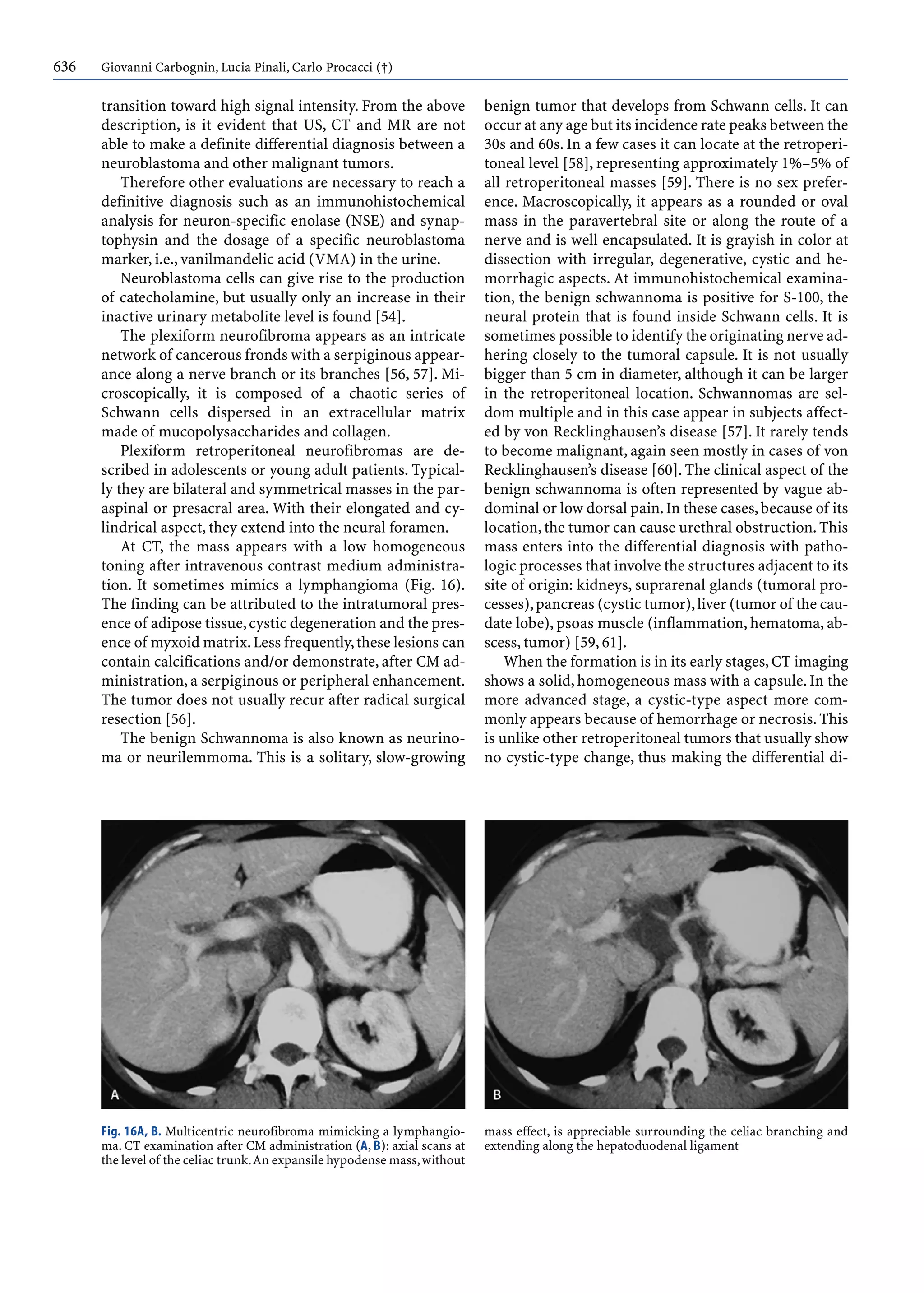 636 Giovanni Carbognin, Lucia Pinali, Carlo Procacci (†)
transition toward high signal intensity. From the above
description, is it evident that US, CT and MR are not
able to make a definite differential diagnosis between a
neuroblastoma and other malignant tumors.
Therefore other evaluations are necessary to reach a
definitive diagnosis such as an immunohistochemical
analysis for neuron-specific enolase (NSE) and synap-
tophysin and the dosage of a specific neuroblastoma
marker, i.e., vanilmandelic acid (VMA) in the urine.
Neuroblastoma cells can give rise to the production
of catecholamine, but usually only an increase in their
inactive urinary metabolite level is found [54].
The plexiform neurofibroma appears as an intricate
network of cancerous fronds with a serpiginous appear-
ance along a nerve branch or its branches [56, 57]. Mi-
croscopically, it is composed of a chaotic series of
Schwann cells dispersed in an extracellular matrix
made of mucopolysaccharides and collagen.
Plexiform retroperitoneal neurofibromas are de-
scribed in adolescents or young adult patients. Typical-
ly they are bilateral and symmetrical masses in the par-
aspinal or presacral area. With their elongated and cy-
lindrical aspect, they extend into the neural foramen.
At CT, the mass appears with a low homogeneous
toning after intravenous contrast medium administra-
tion. It sometimes mimics a lymphangioma (Fig. 16).
The finding can be attributed to the intratumoral pres-
ence of adipose tissue,cystic degeneration and the pres-
ence of myxoid matrix.Less frequently,these lesions can
contain calcifications and/or demonstrate, after CM ad-
ministration, a serpiginous or peripheral enhancement.
The tumor does not usually recur after radical surgical
resection [56].
The benign Schwannoma is also known as neurino-
ma or neurilemmoma. This is a solitary, slow-growing
benign tumor that develops from Schwann cells. It can
occur at any age but its incidence rate peaks between the
30s and 60s. In a few cases it can locate at the retroperi-
toneal level [58], representing approximately 1%–5% of
all retroperitoneal masses [59]. There is no sex prefer-
ence. Macroscopically, it appears as a rounded or oval
mass in the paravertebral site or along the route of a
nerve and is well encapsulated. It is grayish in color at
dissection with irregular, degenerative, cystic and he-
morrhagic aspects. At immunohistochemical examina-
tion, the benign schwannoma is positive for S-100, the
neural protein that is found inside Schwann cells. It is
sometimes possible to identify the originating nerve ad-
hering closely to the tumoral capsule. It is not usually
bigger than 5 cm in diameter, although it can be larger
in the retroperitoneal location. Schwannomas are sel-
dom multiple and in this case appear in subjects affect-
ed by von Recklinghausen’s disease [57]. It rarely tends
to become malignant, again seen mostly in cases of von
Recklinghausen’s disease [60]. The clinical aspect of the
benign schwannoma is often represented by vague ab-
dominal or low dorsal pain.In these cases,because of its
location,the tumor can cause urethral obstruction.This
mass enters into the differential diagnosis with patho-
logic processes that involve the structures adjacent to its
site of origin: kidneys, suprarenal glands (tumoral pro-
cesses),pancreas (cystic tumor),liver (tumor of the cau-
date lobe), psoas muscle (inflammation, hematoma, ab-
scess, tumor) [59, 61].
When the formation is in its early stages,CT imaging
shows a solid, homogeneous mass with a capsule. In the
more advanced stage, a cystic-type aspect more com-
monly appears because of hemorrhage or necrosis.This
is unlike other retroperitoneal tumors that usually show
no cystic-type change, thus making the differential di-
Fig. 16A, B. Multicentric neurofibroma mimicking a lymphangio-
ma. CT examination after CM administration (A, B): axial scans at
the level of the celiac trunk.An expansile hypodense mass,without
mass effect, is appreciable surrounding the celiac branching and
extending along the hepatoduodenal ligament
 