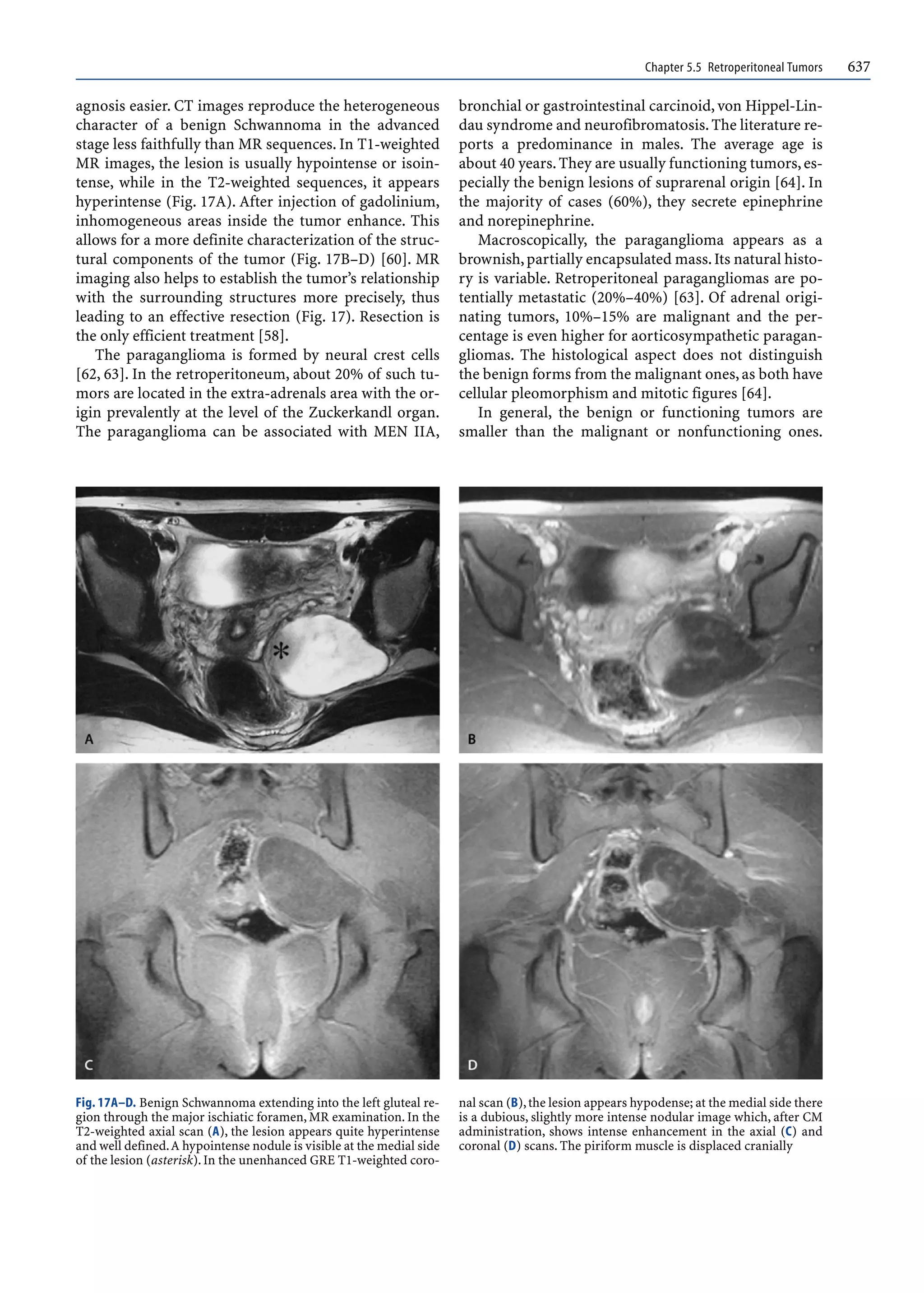 Chapter 5.5 Retroperitoneal Tumors 637
agnosis easier. CT images reproduce the heterogeneous
character of a benign Schwannoma in the advanced
stage less faithfully than MR sequences. In T1-weighted
MR images, the lesion is usually hypointense or isoin-
tense, while in the T2-weighted sequences, it appears
hyperintense (Fig. 17A). After injection of gadolinium,
inhomogeneous areas inside the tumor enhance. This
allows for a more definite characterization of the struc-
tural components of the tumor (Fig. 17B–D) [60]. MR
imaging also helps to establish the tumor’s relationship
with the surrounding structures more precisely, thus
leading to an effective resection (Fig. 17). Resection is
the only efficient treatment [58].
The paraganglioma is formed by neural crest cells
[62, 63]. In the retroperitoneum, about 20% of such tu-
mors are located in the extra-adrenals area with the or-
igin prevalently at the level of the Zuckerkandl organ.
The paraganglioma can be associated with MEN IIA,
bronchial or gastrointestinal carcinoid, von Hippel-Lin-
dau syndrome and neurofibromatosis.The literature re-
ports a predominance in males. The average age is
about 40 years.They are usually functioning tumors,es-
pecially the benign lesions of suprarenal origin [64]. In
the majority of cases (60%), they secrete epinephrine
and norepinephrine.
Macroscopically, the paraganglioma appears as a
brownish,partially encapsulated mass.Its natural histo-
ry is variable. Retroperitoneal paragangliomas are po-
tentially metastatic (20%–40%) [63]. Of adrenal origi-
nating tumors, 10%–15% are malignant and the per-
centage is even higher for aorticosympathetic paragan-
gliomas. The histological aspect does not distinguish
the benign forms from the malignant ones,as both have
cellular pleomorphism and mitotic figures [64].
In general, the benign or functioning tumors are
smaller than the malignant or nonfunctioning ones.
Fig. 17A–D. Benign Schwannoma extending into the left gluteal re-
gion through the major ischiatic foramen, MR examination. In the
T2-weighted axial scan (A), the lesion appears quite hyperintense
and well defined.A hypointense nodule is visible at the medial side
of the lesion (asterisk).In the unenhanced GRE T1-weighted coro-
nal scan (B),the lesion appears hypodense; at the medial side there
is a dubious, slightly more intense nodular image which, after CM
administration, shows intense enhancement in the axial (C) and
coronal (D) scans. The piriform muscle is displaced cranially
 