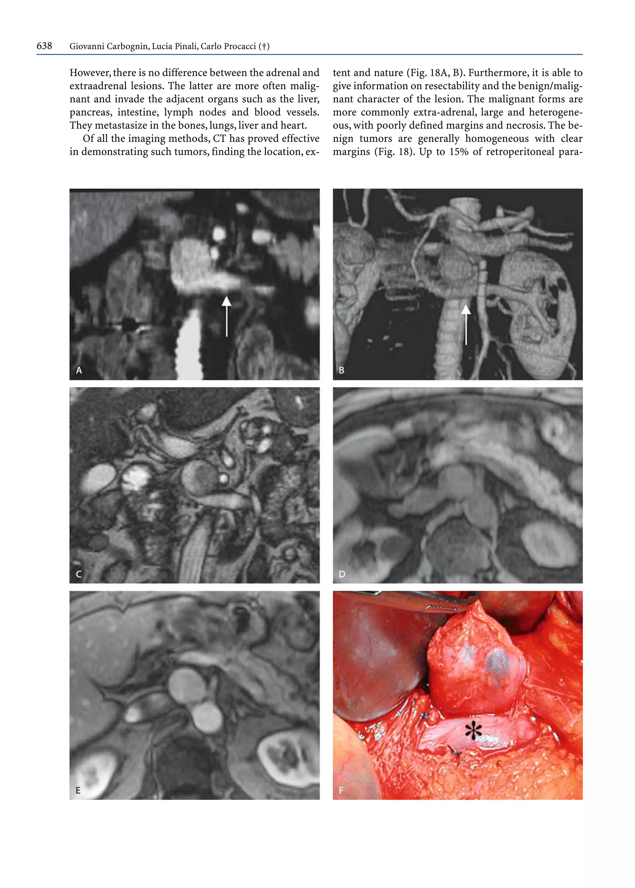 638 Giovanni Carbognin, Lucia Pinali, Carlo Procacci (†)
However,there is no difference between the adrenal and
extraadrenal lesions. The latter are more often malig-
nant and invade the adjacent organs such as the liver,
pancreas, intestine, lymph nodes and blood vessels.
They metastasize in the bones, lungs, liver and heart.
Of all the imaging methods, CT has proved effective
in demonstrating such tumors, finding the location, ex-
tent and nature (Fig. 18A, B). Furthermore, it is able to
give information on resectability and the benign/malig-
nant character of the lesion. The malignant forms are
more commonly extra-adrenal, large and heterogene-
ous, with poorly defined margins and necrosis. The be-
nign tumors are generally homogeneous with clear
margins (Fig. 18). Up to 15% of retroperitoneal para-
 