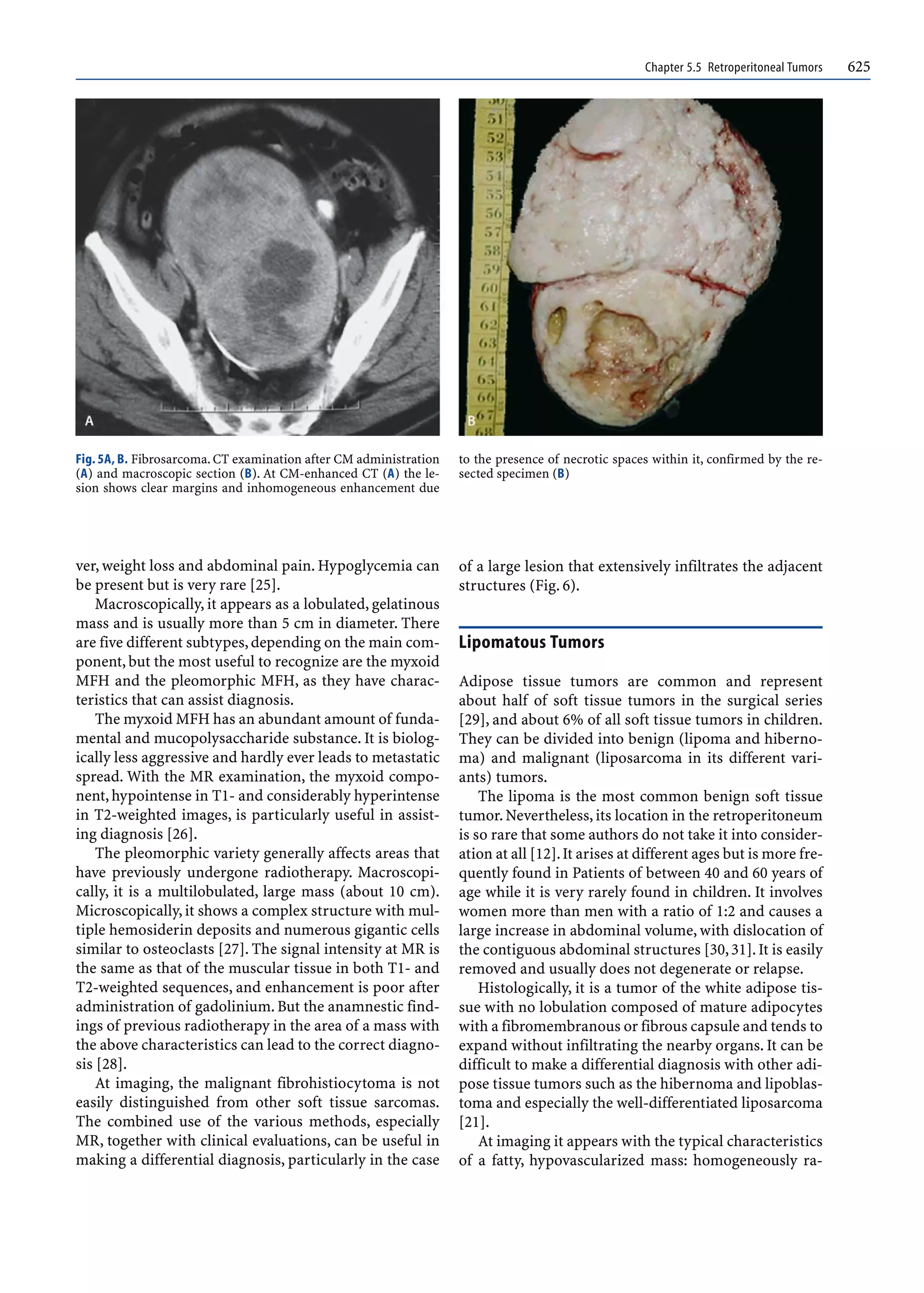 Chapter 5.5 Retroperitoneal Tumors 625
ver, weight loss and abdominal pain. Hypoglycemia can
be present but is very rare [25].
Macroscopically, it appears as a lobulated, gelatinous
mass and is usually more than 5 cm in diameter. There
are five different subtypes,depending on the main com-
ponent, but the most useful to recognize are the myxoid
MFH and the pleomorphic MFH, as they have charac-
teristics that can assist diagnosis.
The myxoid MFH has an abundant amount of funda-
mental and mucopolysaccharide substance. It is biolog-
ically less aggressive and hardly ever leads to metastatic
spread. With the MR examination, the myxoid compo-
nent, hypointense in T1- and considerably hyperintense
in T2-weighted images, is particularly useful in assist-
ing diagnosis [26].
The pleomorphic variety generally affects areas that
have previously undergone radiotherapy. Macroscopi-
cally, it is a multilobulated, large mass (about 10 cm).
Microscopically, it shows a complex structure with mul-
tiple hemosiderin deposits and numerous gigantic cells
similar to osteoclasts [27]. The signal intensity at MR is
the same as that of the muscular tissue in both T1- and
T2-weighted sequences, and enhancement is poor after
administration of gadolinium. But the anamnestic find-
ings of previous radiotherapy in the area of a mass with
the above characteristics can lead to the correct diagno-
sis [28].
At imaging, the malignant fibrohistiocytoma is not
easily distinguished from other soft tissue sarcomas.
The combined use of the various methods, especially
MR, together with clinical evaluations, can be useful in
making a differential diagnosis, particularly in the case
of a large lesion that extensively infiltrates the adjacent
structures (Fig. 6).
Lipomatous Tumors
Adipose tissue tumors are common and represent
about half of soft tissue tumors in the surgical series
[29], and about 6% of all soft tissue tumors in children.
They can be divided into benign (lipoma and hiberno-
ma) and malignant (liposarcoma in its different vari-
ants) tumors.
The lipoma is the most common benign soft tissue
tumor.Nevertheless, its location in the retroperitoneum
is so rare that some authors do not take it into consider-
ation at all [12].It arises at different ages but is more fre-
quently found in Patients of between 40 and 60 years of
age while it is very rarely found in children. It involves
women more than men with a ratio of 1:2 and causes a
large increase in abdominal volume, with dislocation of
the contiguous abdominal structures [30,31].It is easily
removed and usually does not degenerate or relapse.
Histologically, it is a tumor of the white adipose tis-
sue with no lobulation composed of mature adipocytes
with a fibromembranous or fibrous capsule and tends to
expand without infiltrating the nearby organs. It can be
difficult to make a differential diagnosis with other adi-
pose tissue tumors such as the hibernoma and lipoblas-
toma and especially the well-differentiated liposarcoma
[21].
At imaging it appears with the typical characteristics
of a fatty, hypovascularized mass: homogeneously ra-
Fig. 5A, B. Fibrosarcoma. CT examination after CM administration
(A) and macroscopic section (B). At CM-enhanced CT (A) the le-
sion shows clear margins and inhomogeneous enhancement due
to the presence of necrotic spaces within it, confirmed by the re-
sected specimen (B)
 