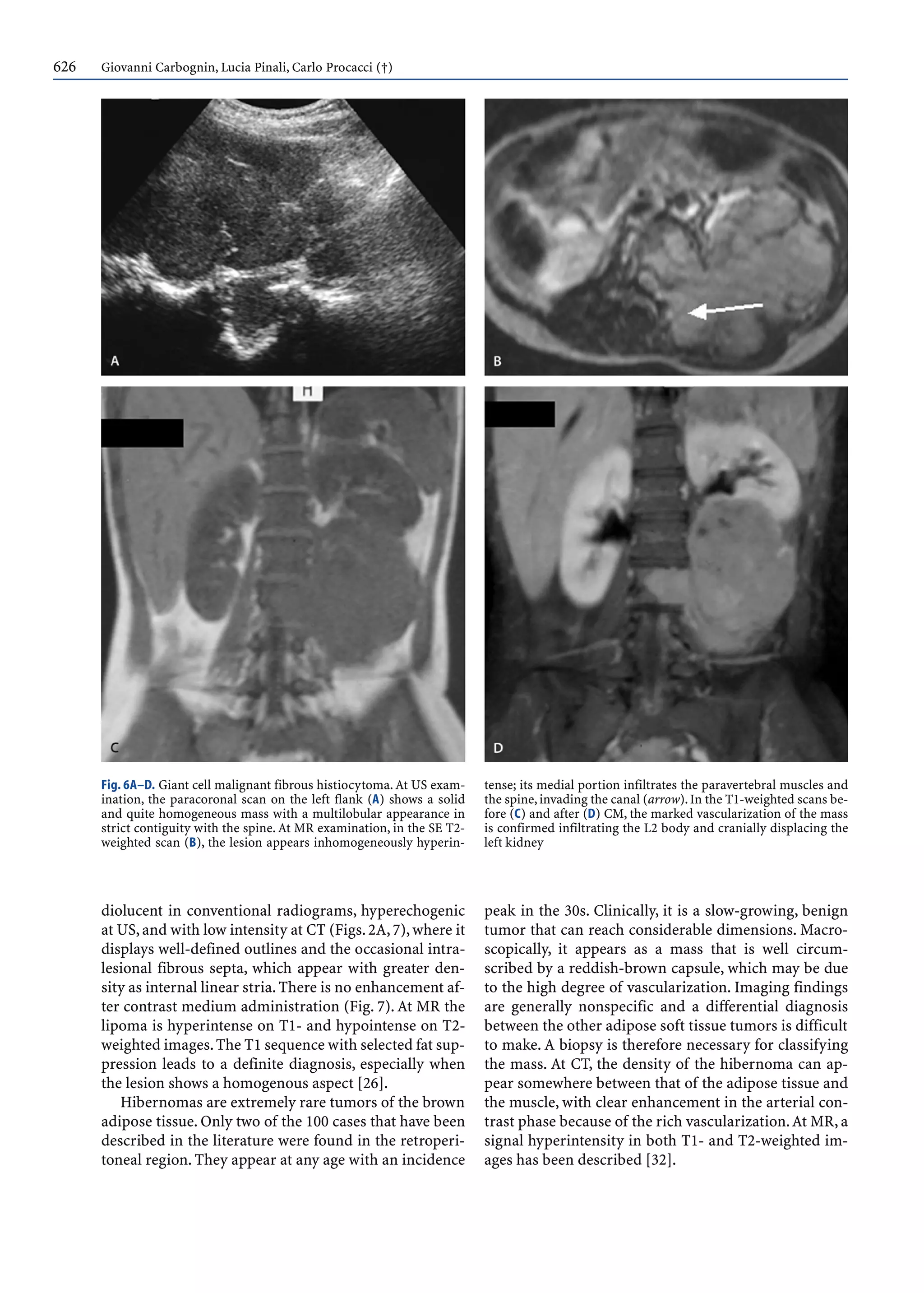 626 Giovanni Carbognin, Lucia Pinali, Carlo Procacci (†)
diolucent in conventional radiograms, hyperechogenic
at US,and with low intensity at CT (Figs.2A,7),where it
displays well-defined outlines and the occasional intra-
lesional fibrous septa, which appear with greater den-
sity as internal linear stria.There is no enhancement af-
ter contrast medium administration (Fig. 7). At MR the
lipoma is hyperintense on T1- and hypointense on T2-
weighted images.The T1 sequence with selected fat sup-
pression leads to a definite diagnosis, especially when
the lesion shows a homogenous aspect [26].
Hibernomas are extremely rare tumors of the brown
adipose tissue. Only two of the 100 cases that have been
described in the literature were found in the retroperi-
toneal region. They appear at any age with an incidence
peak in the 30s. Clinically, it is a slow-growing, benign
tumor that can reach considerable dimensions. Macro-
scopically, it appears as a mass that is well circum-
scribed by a reddish-brown capsule, which may be due
to the high degree of vascularization. Imaging findings
are generally nonspecific and a differential diagnosis
between the other adipose soft tissue tumors is difficult
to make. A biopsy is therefore necessary for classifying
the mass. At CT, the density of the hibernoma can ap-
pear somewhere between that of the adipose tissue and
the muscle, with clear enhancement in the arterial con-
trast phase because of the rich vascularization.At MR, a
signal hyperintensity in both T1- and T2-weighted im-
ages has been described [32].
Fig. 6A–D. Giant cell malignant fibrous histiocytoma.At US exam-
ination, the paracoronal scan on the left flank (A) shows a solid
and quite homogeneous mass with a multilobular appearance in
strict contiguity with the spine. At MR examination, in the SE T2-
weighted scan (B), the lesion appears inhomogeneously hyperin-
tense; its medial portion infiltrates the paravertebral muscles and
the spine,invading the canal (arrow).In the T1-weighted scans be-
fore (C) and after (D) CM, the marked vascularization of the mass
is confirmed infiltrating the L2 body and cranially displacing the
left kidney
 