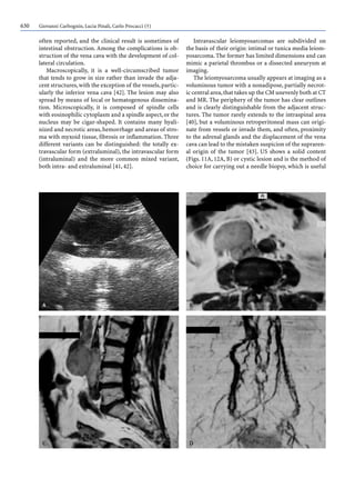 630 Giovanni Carbognin, Lucia Pinali, Carlo Procacci (†)
often reported, and the clinical result is sometimes of
intestinal obstruction. Among the complications is ob-
struction of the vena cava with the development of col-
lateral circulation.
Macroscopically, it is a well-circumscribed tumor
that tends to grow in size rather than invade the adja-
cent structures,with the exception of the vessels,partic-
ularly the inferior vena cava [42]. The lesion may also
spread by means of local or hematogenous dissemina-
tion. Microscopically, it is composed of spindle cells
with eosinophilic cytoplasm and a spindle aspect,or the
nucleus may be cigar-shaped. It contains many hyali-
nized and necrotic areas,hemorrhage and areas of stro-
ma with myxoid tissue, fibrosis or inflammation. Three
different variants can be distinguished: the totally ex-
travascular form (extraluminal), the intravascular form
(intraluminal) and the more common mixed variant,
both intra- and extraluminal [41, 42].
Intravascular leiomyosarcomas are subdivided on
the basis of their origin: intimal or tunica media leiom-
yosarcoma. The former has limited dimensions and can
mimic a parietal thrombus or a dissected aneurysm at
imaging.
The leiomyosarcoma usually appears at imaging as a
voluminous tumor with a nonadipose, partially necrot-
ic central area,that takes up the CM unevenly both at CT
and MR. The periphery of the tumor has clear outlines
and is clearly distinguishable from the adjacent struc-
tures. The tumor rarely extends to the intraspinal area
[40], but a voluminous retroperitoneal mass can origi-
nate from vessels or invade them, and often, proximity
to the adrenal glands and the displacement of the vena
cava can lead to the mistaken suspicion of the supraren-
al origin of the tumor [43]. US shows a solid content
(Figs. 11A, 12A, B) or cystic lesion and is the method of
choice for carrying out a needle biopsy, which is useful
 