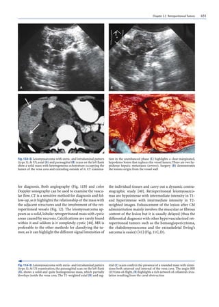 Chapter 5.5 Retroperitoneal Tumors 631
for diagnosis. Both angiography (Fig. 11B) and color
Doppler sonography can be used to examine the vascu-
lar flow. CT is a sensitive method for diagnosis and fol-
low-up,as it highlights the relationship of the mass with
the adjacent structures and the involvement of the ret-
roperitoneal vessels (Fig. 12). The leiomyosarcoma ap-
pears as a solid,lobular retroperitoneal mass with cystic
areas caused by necrosis. Calcifications are rarely found
within it and seldom is it completely cystic [44]. MR is
preferable to the other methods for classifying the tu-
mor,as it can highlight the different signal intensities of
the individual tissues and carry out a dynamic contra-
stographic study [40]. Retroperitoneal leiomyosarco-
mas are hypointense with intermediate intensity in T1-
and hyperintense with intermediate intensity in T2-
weighted images. Enhancement of the lesion after CM
administration mainly involves the muscular or fibrous
content of the lesion but it is usually delayed (thus the
differential diagnosis with other hypervascularized ret-
roperitoneal tumors such as the hemangiopericytoma,
the rhabdomyosarcoma and the extraskeletal Ewing’s
sarcoma is easier) [41] (Fig. 11C, D).
Fig. 12A–D. Leiomyosarcoma with extra- and intraluminal pattern
(type 3).At US,axial (A) and parasagittal (B) scans on the left flank
show a solid mass with heterogeneous echotexture occupying the
lumen of the vena cava and extending outside of it. CT examina-
tion in the unenhanced phase (C) highlights a clear-marginated,
hypodense lesion that replaces the vessel lumen. There are two hy-
podense hepatic metastases (arrows). Surgery (D) demonstrates
the lesions origin from the vessel wall
Fig. 11A–D. Leiomyosarcoma with extra- and intraluminal pattern
(type 3).At US examination, the parasagittal scan on the left flank
(A), shows a solid and quite homogeneous mass, which partially
develops inside the vena cava. The T1-weighted axial (B) and sag-
ittal (C) scans confirm the presence of a rounded mass with exten-
sions both external and internal of the vena cava. The angio-MR
(2D time-of-flight,(D) highlights a rich network of collateral circu-
lation resulting from the caval obstruction
 