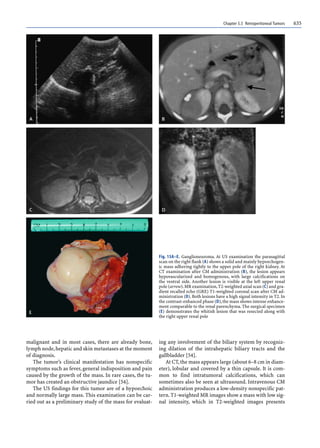 Chapter 5.5 Retroperitoneal Tumors 635
malignant and in most cases, there are already bone,
lymph node,hepatic and skin metastases at the moment
of diagnosis.
The tumor’s clinical manifestation has nonspecific
symptoms such as fever, general indisposition and pain
caused by the growth of the mass. In rare cases, the tu-
mor has created an obstructive jaundice [54].
The US findings for this tumor are of a hypoechoic
and normally large mass. This examination can be car-
ried out as a preliminary study of the mass for evaluat-
ing any involvement of the biliary system by recogniz-
ing dilation of the intrahepatic biliary tracts and the
gallbladder [54].
At CT,the mass appears large (about 6–8 cm in diam-
eter), lobular and covered by a thin capsule. It is com-
mon to find intratumoral calcifications, which can
sometimes also be seen at ultrasound. Intravenous CM
administration produces a low-density nonspecific pat-
tern.T1-weighted MR images show a mass with low sig-
nal intensity, which in T2-weighted images presents
Fig. 15A–E. Ganglioneuroma. At US examination the parasagittal
scan on the right flank (A) shows a solid and mainly hypoechogen-
ic mass adhering tightly to the upper pole of the right kidney. At
CT examination after CM administration (B), the lesion appears
hypovascularized and homogenous, with large calcifications on
the ventral side. Another lesion is visible at the left upper renal
pole (arrow).MR examination,T2-weighted axial scan (C) and gra-
dient recalled echo (GRE) T1-weighted coronal scan after CM ad-
ministration (D).Both lesions have a high signal intensity in T2.In
the contrast-enhanced phase (D),the mass shows intense enhance-
ment comparable to the renal parenchyma. The surgical specimen
(E) demonstrates the whitish lesion that was resected along with
the right upper renal pole
 