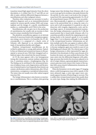 636 Giovanni Carbognin, Lucia Pinali, Carlo Procacci (†)
transition toward high signal intensity. From the above
description, is it evident that US, CT and MR are not
able to make a definite differential diagnosis between a
neuroblastoma and other malignant tumors.
Therefore other evaluations are necessary to reach a
definitive diagnosis such as an immunohistochemical
analysis for neuron-specific enolase (NSE) and synap-
tophysin and the dosage of a specific neuroblastoma
marker, i.e., vanilmandelic acid (VMA) in the urine.
Neuroblastoma cells can give rise to the production
of catecholamine, but usually only an increase in their
inactive urinary metabolite level is found [54].
The plexiform neurofibroma appears as an intricate
network of cancerous fronds with a serpiginous appear-
ance along a nerve branch or its branches [56, 57]. Mi-
croscopically, it is composed of a chaotic series of
Schwann cells dispersed in an extracellular matrix
made of mucopolysaccharides and collagen.
Plexiform retroperitoneal neurofibromas are de-
scribed in adolescents or young adult patients. Typical-
ly they are bilateral and symmetrical masses in the par-
aspinal or presacral area. With their elongated and cy-
lindrical aspect, they extend into the neural foramen.
At CT, the mass appears with a low homogeneous
toning after intravenous contrast medium administra-
tion. It sometimes mimics a lymphangioma (Fig. 16).
The finding can be attributed to the intratumoral pres-
ence of adipose tissue,cystic degeneration and the pres-
ence of myxoid matrix.Less frequently,these lesions can
contain calcifications and/or demonstrate, after CM ad-
ministration, a serpiginous or peripheral enhancement.
The tumor does not usually recur after radical surgical
resection [56].
The benign Schwannoma is also known as neurino-
ma or neurilemmoma. This is a solitary, slow-growing
benign tumor that develops from Schwann cells. It can
occur at any age but its incidence rate peaks between the
30s and 60s. In a few cases it can locate at the retroperi-
toneal level [58], representing approximately 1%–5% of
all retroperitoneal masses [59]. There is no sex prefer-
ence. Macroscopically, it appears as a rounded or oval
mass in the paravertebral site or along the route of a
nerve and is well encapsulated. It is grayish in color at
dissection with irregular, degenerative, cystic and he-
morrhagic aspects. At immunohistochemical examina-
tion, the benign schwannoma is positive for S-100, the
neural protein that is found inside Schwann cells. It is
sometimes possible to identify the originating nerve ad-
hering closely to the tumoral capsule. It is not usually
bigger than 5 cm in diameter, although it can be larger
in the retroperitoneal location. Schwannomas are sel-
dom multiple and in this case appear in subjects affect-
ed by von Recklinghausen’s disease [57]. It rarely tends
to become malignant, again seen mostly in cases of von
Recklinghausen’s disease [60]. The clinical aspect of the
benign schwannoma is often represented by vague ab-
dominal or low dorsal pain.In these cases,because of its
location,the tumor can cause urethral obstruction.This
mass enters into the differential diagnosis with patho-
logic processes that involve the structures adjacent to its
site of origin: kidneys, suprarenal glands (tumoral pro-
cesses),pancreas (cystic tumor),liver (tumor of the cau-
date lobe), psoas muscle (inflammation, hematoma, ab-
scess, tumor) [59, 61].
When the formation is in its early stages,CT imaging
shows a solid, homogeneous mass with a capsule. In the
more advanced stage, a cystic-type aspect more com-
monly appears because of hemorrhage or necrosis.This
is unlike other retroperitoneal tumors that usually show
no cystic-type change, thus making the differential di-
Fig. 16A, B. Multicentric neurofibroma mimicking a lymphangio-
ma. CT examination after CM administration (A, B): axial scans at
the level of the celiac trunk.An expansile hypodense mass,without
mass effect, is appreciable surrounding the celiac branching and
extending along the hepatoduodenal ligament
 