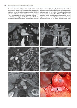638 Giovanni Carbognin, Lucia Pinali, Carlo Procacci (†)
However,there is no difference between the adrenal and
extraadrenal lesions. The latter are more often malig-
nant and invade the adjacent organs such as the liver,
pancreas, intestine, lymph nodes and blood vessels.
They metastasize in the bones, lungs, liver and heart.
Of all the imaging methods, CT has proved effective
in demonstrating such tumors, finding the location, ex-
tent and nature (Fig. 18A, B). Furthermore, it is able to
give information on resectability and the benign/malig-
nant character of the lesion. The malignant forms are
more commonly extra-adrenal, large and heterogene-
ous, with poorly defined margins and necrosis. The be-
nign tumors are generally homogeneous with clear
margins (Fig. 18). Up to 15% of retroperitoneal para-
 
