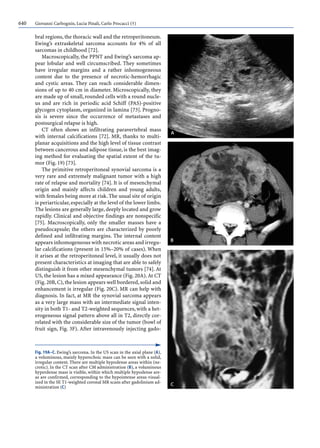 640 Giovanni Carbognin, Lucia Pinali, Carlo Procacci (†)
bral regions, the thoracic wall and the retroperitoneum.
Ewing’s extraskeletal sarcoma accounts for 4% of all
sarcomas in childhood [72].
Macroscopically, the PPNT and Ewing’s sarcoma ap-
pear lobular and well circumscribed. They sometimes
have irregular margins and a rather inhomogeneous
content due to the presence of necrotic-hemorrhagic
and cystic areas. They can reach considerable dimen-
sions of up to 40 cm in diameter. Microscopically, they
are made up of small, rounded cells with a round nucle-
us and are rich in periodic acid Schiff (PAS)-positive
glycogen cytoplasm, organized in lamina [73]. Progno-
sis is severe since the occurrence of metastases and
postsurgical relapse is high.
CT often shows an infiltrating paravertebral mass
with internal calcifications [72]. MR, thanks to multi-
planar acquisitions and the high level of tissue contrast
between cancerous and adipose tissue, is the best imag-
ing method for evaluating the spatial extent of the tu-
mor (Fig. 19) [73].
The primitive retroperitoneal synovial sarcoma is a
very rare and extremely malignant tumor with a high
rate of relapse and mortality [74]. It is of mesenchymal
origin and mainly affects children and young adults,
with females being more at risk. The usual site of origin
is periarticular,especially at the level of the lower limbs.
The lesions are generally large, deeply located and grow
rapidly. Clinical and objective findings are nonspecific
[75]. Macroscopically, only the smaller masses have a
pseudocapsule; the others are characterized by poorly
defined and infiltrating margins. The internal content
appears inhomogeneous with necrotic areas and irregu-
lar calcifications (present in 15%–20% of cases). When
it arises at the retroperitoneal level, it usually does not
present characteristics at imaging that are able to safely
distinguish it from other mesenchymal tumors [74]. At
US, the lesion has a mixed appearance (Fig. 20A).At CT
(Fig.20B,C),the lesion appears well bordered,solid and
enhancement is irregular (Fig. 20C). MR can help with
diagnosis. In fact, at MR the synovial sarcoma appears
as a very large mass with an intermediate signal inten-
sity in both T1- and T2-weighted sequences, with a het-
erogeneous signal pattern above all in T2, directly cor-
related with the considerable size of the tumor (bowl of
fruit sign, Fig. 3F). After intravenously injecting gado-
Fig. 19A–C. Ewing’s sarcoma. In the US scan in the axial plane (A),
a voluminous, mainly hyperechoic mass can be seen with a solid,
irregular content. There are multiple hypodense areas within (ne-
crotic). In the CT scan after CM administration (B), a voluminous
hyperdense mass is visible, within which multiple hypodense are-
as are confirmed, corresponding to the hypointense areas visual-
ized in the SE T1-weighted coronal MR scans after gadolinium ad-
ministration (C)
 