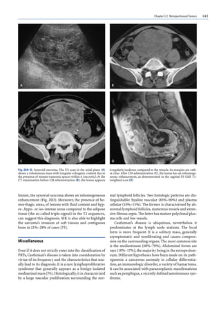 Chapter 5.5 Retroperitoneal Tumors 641
linium, the synovial sarcoma shows an inhomogeneous
enhancement (Fig. 20D). Moreover, the presence of he-
morrhagic areas, of lesions with fluid content and hyp-
er-, hypo- or iso-intense areas compared to the adipose
tissue (the so-called triple-signal) in the T2 sequences,
can suggest this diagnosis. MR is also able to highlight
the sarcoma’s invasion of soft tissues and contiguous
bone in 21%–28% of cases [75].
Miscellaneous
Even if it does not strictly enter into the classification of
PRTs, Castleman’s disease is taken into consideration by
virtue of its frequency and the characteristics that usu-
ally lead to its diagnosis. It is a rare lymphoproliferative
syndrome that generally appears as a benign isolated
mediastinal mass [76]. Histologically, it is characterized
by a large vascular proliferation surrounding the nor-
mal lymphoid follicles. Two histologic patterns are dis-
tinguishable: hyaline vascular (85%–90%) and plasma
cellular (10%–15%). The former is characterized by ab-
normal lymphoid follicles,numerous vessels and exten-
sive fibrous septa.The latter has mature polyclonal plas-
ma cells and few vessels.
Castleman’s disease is ubiquitous, nevertheless it
predominates at the lymph node stations. The local
form is more frequent. It is a solitary mass, generally
asymptomatic and nonfiltrating and causes compres-
sion on the surrounding organs. The most common site
is the mediastinum (60%–70%). Abdominal forms are
rare (10%–17%),the majority being in the retroperiton-
eum. Different hypotheses have been made on its path-
ogenesis: a cancerous anomaly in cellular differentia-
tion, an immunologic disorder, a variety of hamartoma.
It can be associated with paraneoplastic manifestations
such as pemphigus,a recently defined autoimmune syn-
drome.
Fig. 20A–D. Synovial sarcoma. The US scan in the axial plane (A)
shows a voluminous mass with irregular echogenic content due to
the presence of minute transonic spaces within it (necrotic).At the
CT examination before CM administration (B), the lesion appears
irregularly isodense compared to the muscle. Its margins are rath-
er clear.After CM administration (C), the lesion has an inhomoge-
neous enhancement, as demonstrated in the sagittal FS GRE T1-
weighted scan (D)
 