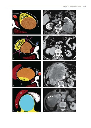 Chapter 5.5 Retroperitoneal Tumors 621
 