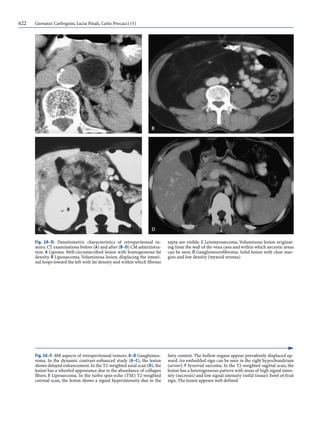 622 Giovanni Carbognin, Lucia Pinali, Carlo Procacci (†)
Fig. 2A–D. Densitometric characteristics of retroperitoneal tu-
mors.CT examinations before (A) and after (B–D) CM administra-
tion. A Lipoma. Well-circumscribed lesion with homogeneous fat
density. B Liposarcoma. Voluminous lesion, displacing the intesti-
nal loops toward the left with fat density and within which fibrous
septa are visible. C Leiomyosarcoma. Voluminous lesion originat-
ing from the wall of the vena cava and within which necrotic areas
can be seen. D Ganglioneurofibroma. Solid lesion with clear mar-
gins and low density (myxoid stroma)
Fig. 3A–F. MR aspects of retroperitoneal tumors. A–D Ganglioneu-
roma. In the dynamic contrast-enhanced study (A–C), the lesion
shows delayed enhancement.In the T2-weighted axial scan (D),the
lesion has a whorled appearance due to the abundance of collagen
fibers. E Liposarcoma. In the turbo spin-echo (TSE) T2-weighted
coronal scan, the lesion shows a signal hyperintensity due to the
fatty content. The hollow organs appear prevalently displaced up-
ward.An embedded sign can be seen in the right hypochondrium
(arrow). F Synovial sarcoma. In the T2-weighted sagittal scan, the
lesion has a heterogeneous pattern with areas of high signal inten-
sity (necrosis) and low signal intensity (solid tissue): bowl of fruit
sign. The lesion appears well defined
 