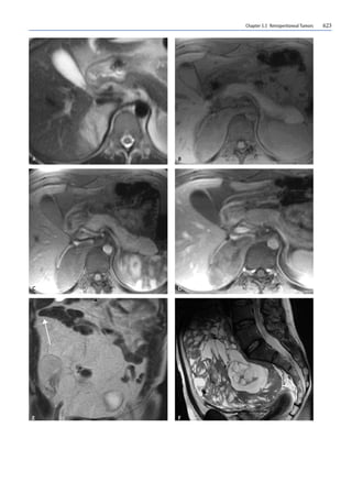 Chapter 5.5 Retroperitoneal Tumors 623
 