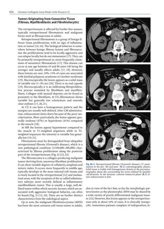 624 Giovanni Carbognin, Lucia Pinali, Carlo Procacci (†)
Tumors Originating from Connective Tissue
(Fibrous, Myofibroblastic and Fibrohistiocytic)
The retroperitoneum is affected by border-line masses,
typically retroperitoneal fibromatosis and malignant
forms such as fibrosarcoma in adults.
Retroperitoneal fibromatosis is a group of benign fi-
brous tissue proliferations, with no sign of inflamma-
tion or tumor [14, 16]. The biological behavior is some-
where between benign fibrous lesions and fibrosarco-
ma: the proliferations tend to be locally aggressive and
can relapse locally but do not metastasize [17].They can
be primarily retroperitoneal or, more frequently, exten-
sions of mesenteric fibromatosis [17]. This disease can
occur at any age between 10 and 80 years (40 being the
average) and usually affects adults [17, 18]. However,
these lesions are rare: 10%–15% of cases are associated
with familial polyposis syndrome or Gardner syndrome
[19]. Macroscopically, the lesion appears as a solid mass
of variable size (1–30 cm) [18]. There is no real capsule
[19]. Microscopically, it is an infiltrating fibroprolifera-
tive process sustained by fibroblasts and myofibro-
blasts. Collagen with myxoid deposits can be found in
proximity to the fibroblasts. At US, fibromatosis shows
variable but generally low echotexture and smooth,
clear outlines [17, 20, 21].
At CT, it can have a homogeneous pattern and the
margins are usually well-defined.After CM administra-
tion, enhancement slows down because of the poor vas-
cularization. More particularly, the lesion appears gen-
erally isodense (47%) or hyperdense (41%) compared
to the muscle [18].
At MR the lesions appear hypointense compared to
the muscle in T1-weighted sequences while in T2-
weighted sequences the intensity is variable but gener-
ally low [19, 21].
Fibromatosis must be distinguished from idiopathic
retroperitoneal fibrosis (Ormond’s disease), which is a
rare pathological condition (1/100,000–200,000) char-
acterized by fibrous proliferation along the posterior
part of the retroperitoneum (Fig. 4) [22, 23].
The fibrosarcoma is a collagen-producing malignant
tumor deriving from cancerous fibroblast proliferation.
It can show variable degrees of cellularity,anaplasia and
mitotic index. It occurs more frequently in middle age,
typically develops in the more internal soft tissues and
is rarely located in the retroperitoneal [12] and medias-
tinal areas,with the exception of the so called inflamma-
tory subtype, more recently defined as inflammatory
myofibroblastic tumor. This is usually a large, well-de-
fined tumor within which necrotic focuses,which are as-
sociated with aggressive biological behavior, can often
be found (Fig. 5) [12, 24]. There are no further distinct
characteristics from the radiological aspect.
Up to now, the malignant fibrohistiocytoma (MFH)
has been the most common soft tissue tumor in adults,
also in view of the fact that, so far, the morphologic pat-
tern known as the pleomorphic MFH may be shared by
a wide variety of poorly differentiated malignant mass-
es [12].However,this lesion appears in the retroperiton-
eum only in about 16% of cases. It is clinically nonspe-
cific. Sometimes patients complain of indisposition, fe-
Fig. 4A–C. Retroperitoneal fibrosis (Ormond’s disease). CT exam-
ination in the pre- (A) and post- (B, C) contrastographic phases.
Solid tissue is visible with homogeneous density in the precontra-
stographic phase (A), surrounding the aorta outlined by lamellar
calcifications. In the dynamic contrast-enhanced phase (B, C) le-
sion enhancement is slow
 