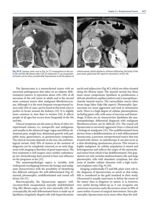 Chapter 5.5 Retroperitoneal Tumors 627
The liposarcoma is a mesenchymal tumor with an
uncertain pathogenesis that takes on an adipose diffe-
rentiation pattern. It represents about 16%–18% of all
sarcomas of the soft tissue in adults and is the second
most common tumor after malignant fibrohistiocyto-
ma.Although it is the most frequent retroperitoneal tu-
mor,only 14% of cases can be found at this level,since it
prefers to locate around the kidneys [33]. It is slightly
more common in men than in women [34]. It affects
people of all ages but occurs more frequently in the 50s
and 60s.
Clinical symptoms are the same as those of other ret-
roperitoneal tumors, i.e., nonspecific and ambiguous,
and usually in the advanced stage: vague and diffuse ab-
dominal pain, weight loss, abdominal growth with pal-
pable mass, gastroenteric or genitourinary symptoms.
The clinical outcome depends on the size,site and histo-
logical variant. Only 50% of tumors at the moment of
diagnosis can be completely removed, so an early diag-
nosis with imaging is therefore of great importance.The
best treatment is still surgery since neither radiothera-
py nor chemotherapy have proved to have any influence
on the prognosis so far [33].
The anatomopathologic aspect is variable, with
widespread overlapping between the benign and malig-
nant characteristics with the possibility of identifying
five different subtypes: the well-differentiated (Fig. 8),
myxoid, pleomorphic, undifferentiated and round cell
forms [34–37].
Macroscopically, the liposarcoma appears well-
circumscribed, encapsulated, typically multilobulated
(Fig. 8B); fibrous septa can be seen internally [38]. Mi-
croscopically, the well-differentiated form is made up of
lipoblasts, irregularly shaped cells with hyperchromatic
nuclei and adipocytes (Fig.8C),which are often situated
along the fibrous septa. The myxoid variant has three
main tissue components: lipoblasts in proliferation, a
delicate plexiform capillary pattern and a mucopolysac-
charide myxoid matrix. The extracellular mucin often
forms large lakes (lake-like aspect). Pleomorphic lipo-
sarcomas are more aggressive and tend to metastasize
early. There is a high degree of cellular pleomorphism,
including giant cells, with areas of necrosis and hemor-
rhage. If there are no characteristic lipoblasts, the ana-
tomopathologic differential diagnosis with malignant
fibrohistiocytoma can be difficult [35]. The round cell
liposarcoma is extremely aggressive from a clinical and
a biological standpoint [35]. The undifferentiated form
derives from a dedifferentiation of a well-differentiated
liposarcoma, a previous retroperitoneal tumor that was
treated with chemo- or radiotherapy.It can also recur as
a slow-developing, spontaneous process. This variant is
highly malignant. Its cellular population is mixed and
heterogeneous and reflects the origin of the mesenchy-
mal tumor from which it has dedifferentiated.This pop-
ulation not only includes multinucleated cells and large
pleomorphic cells with abundant cytoplasm, but also
nests of smaller cellular elements with a high nucle-
us/cytoplasm ratio (Fig. 9) [39].
Imaging,traditionally CT and MR,plays a key role in
the diagnosis of liposarcomas, so much so that today,
MR is considered as the gold standard in their study.
Ultrasound is usually used more to define the extent of
the tumor than to diagnose its nature. It is, however,
very useful during follow-up as it can recognize any
cancerous recurrence early. Recurrence arises in 90% of
cases within 10 years of surgical intervention. Since ple-
omorphic liposarcomas recur more often than the well-
Fig. 7A, B. Lipoma,same case as Fig.2a.CT examination in the ear-
ly (A) and late (B) phases after CM.At enhanced CT,an encapsulat-
ed lesion can be seen,considerably hypointense in all the phases of
enhancement,which displaces,without infiltrating,the body of the
pancreatic gland and the superior mesenteric artery (A)
 