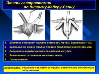 гастростомия по штамму кадеру
