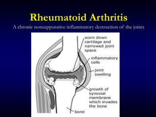 Rheumatoid Arthritis
A chronic nonsuppurative inflammatory destruction of the joints
 