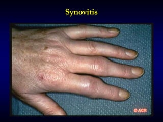 Synovitis
 