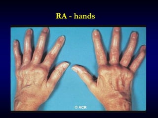 RA - hands
 