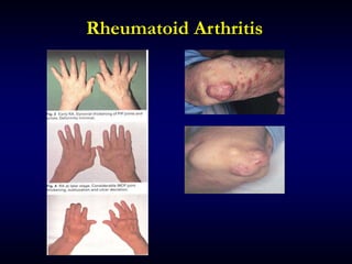Rheumatoid Arthritis
 