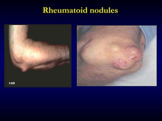 Rheumatoid nodules
 