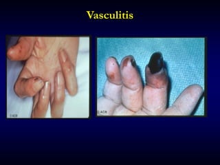 Vasculitis
 