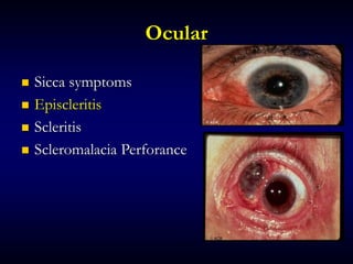 Ocular
 Sicca symptoms
 Episcleritis
 Scleritis
 Scleromalacia Perforance
 