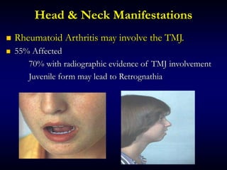 Head & Neck Manifestations
 Rheumatoid Arthritis may involve the TMJ.
 55% Affected
70% with radiographic evidence of TMJ involvement
Juvenile form may lead to Retrognathia
 