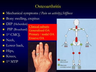 Osteoarthritis
 Mechanical symptoms ( Pain on activity),Stiffness
 Bony swelling, crepitus
 DIP (Heberden)
 PIP (Bouchard)
 1st CMCJ,
 Neck,
 Lower back,
 Hips,
 Knees,
 1st MTP
Clinical subsets
Generalised OA
Primary / nodal OA
Erosive OA
 