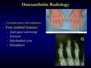 Osteoarthritis Radiology
 ( Correlate poorly with symptoms )
 Four cardinal features:
 Joint space narrowing
 Sclerosis
 Subchondral cysts
 Osteophytes
 