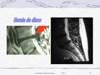 Hernia de disco 
