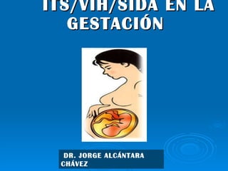 ITS/VIH/SIDA EN LA GESTACIÓN DR. JORGE ALCÁNTARA CHÁVEZ 