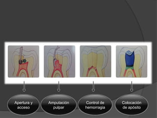 apexogenesis y apexificacion | PPTX