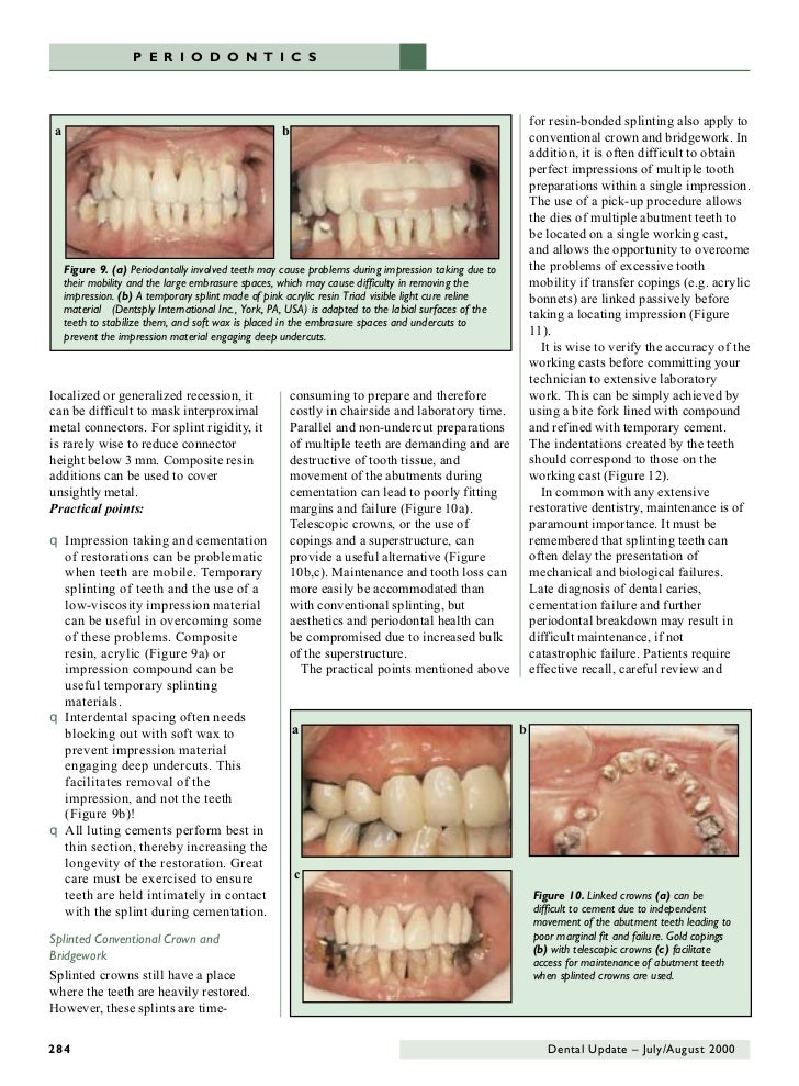 63668245 dentalupdateperiodontalsplintingingeneraldentalpracti…