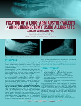 FIXATION OF A LONG-ARM AUSTIN/VALENTI
/AKIN BUNIONECTOMY USING ALLOGRAFTS
(SCHULMAN CORTICAL BONE PINS)
INTRODUCTION
Dr. Daniel Schulman provided a consultation to a 54-year-old
healthy female clinical nutritionist for a painful right bunion
and great toe joint pain after wider shoes and padding failed
to deliver any relief.
Upon examination, pain was palpated along the medial first
metatarsal head without bursa formation. No effusion was
noted, although the right first metatarsophalangeal joint
(MPJ) range of motion was limited without crepitus.
Review of the radiographic findings (Figures 1-3) revealed an
elevated hallux abductovalgus angle, moderately increased
first intermetatarsal and metatarsus adductus angles,
abnormal tibial sesamoid position, slightly elevated first
metatarsal and mild dorsal osteophyte first metatarsal head.
There was also a slightly elevated distal articular set angle.
The surgeon selected a distal first metatarsal osteotomy (long-
arm “V” type Austin), Valenti arthroplasty, and repositional
hallux phalangeal osteotomy (Akin) as the procedures to
correct the above clinical and radiographic abnormalities
for the right foot. Instead of cannulated cortical/cancellous
metallic screws traditional for this type of operation, this case
features the use of two 2.4 mm diameter allograft cortical
bone pins (Schulman Cortical Bone Pins) as the preferred
method to fixate the distal first metatarsal and a third cortical
bone pin to fixate the phalangeal osteotomy.
Each of these osteotomies may utilize one to two allograft
cortical bone pins per surgeon’s preference.
Keywords: Cortical Bone Pin, Allograft, Austin, Valenti, Akin,
Bunionectomy, MPJ,Arthrodesis,Fusion,RegenerativeMedicine
SURGICALTECHNIQUE
This study includes the following techniques:
•	 Bone remodeling of the first metatarsal head and
phalangeal base of hallux using a saggital saw;
•	 Passage of a McGlamery elevator beneath the first
metatarsal head to release fibrous adhesions of the
sesamoid apparatus;
•	 Two converging osteotomies involving the dorsal aspect
of the first MPJ (Valenti).
Upon completion of the dorsal long-arm “V” osteotomy
and lateral displacement of the metatarsal head, manual
compression is utilized along with one 3/32” Steinmann pin
and one temporary 0.45” K-wire or two 3/32” Steinmann pins,
depending on whether one or two bone pins will be utilized
for fixation. Steinmann pins and/or K-wire are positioned
parallel with each other, angled from dorsal-distal-lateral to
plantar-proximal-medial. No bone clamp is necessary.
NOTE: It is extremely important to perform all bone
remodeling with power saw/burr before insertion of
allograft cortical bone pins to prevent loosening of implant.
[Figures 1-2] Patient’s Pre-operative Radiographs: 1) Anteroposterior (AP); 2) Lateral
Daniel S. Schulman, DPM, FACFAS
Arizona Institute of Footcare Physicians - Mesa, AZ
1 2
1
 