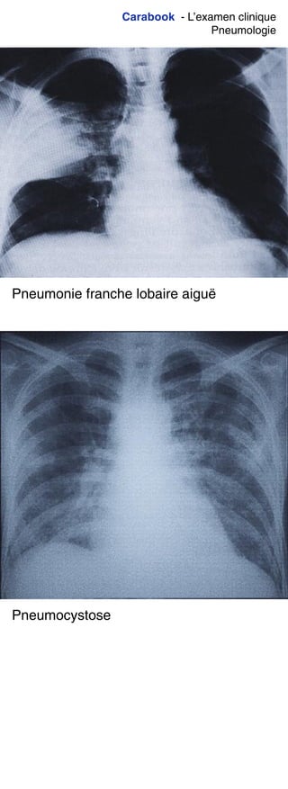 Carabook - L’examen clinique
Pneumologie
Pneumonie franche lobaire aiguë
Pneumocystose
 