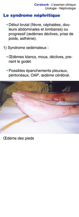 Carabook - L’examen clinique
Urologie - Néphrologie
Le syndrome néphritique
• Début brutal (fièvre, céphalées, dou-
leurs abdominales et lombaires) ou
progressif (œdèmes déclives, prise de
poids, asthénie).
1) Syndrome œdémateux :
• Œdèmes blancs, mous, déclives, pre-
nant le godet.
• Possibles épanchements pleuraux,
péritonéaux, OAP, œdème cérébral.
Œdème des pieds
 