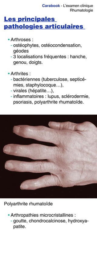 Carabook - L’examen clinique
Rhumatologie
Les principales
pathologies articulaires
• Arthroses :
- ostéophytes, ostéocondensation,
géodes
- 3 localisations fréquentes : hanche,
genou, doigts.
• Arthrites :
- bactériennes (tuberculose, septicé-
mies, staphylocoque…),
- virales (hépatite…),
- inflammatoires : lupus, sclérodermie,
psoriasis, polyarthrite rhumatoïde.
Polyarthrite rhumatoïde
• Arthropathies microcristallines :
- goutte, chondrocalcinose, hydroxya-
patite.
 