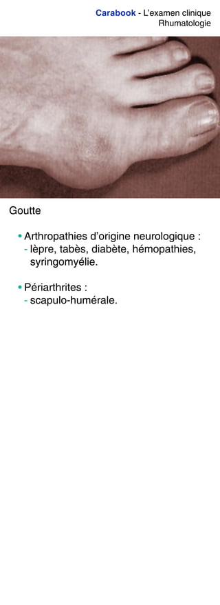 Carabook - L’examen clinique
Rhumatologie
Goutte
• Arthropathies d’origine neurologique :
- lèpre, tabès, diabète, hémopathies,
syringomyélie.
• Périarthrites :
- scapulo-humérale.
 
