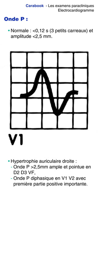 Carabook - Les examens paracliniques
Electrocardiogramme
Onde P :
• Normale : <0,12 s (3 petits carreaux) et
amplitude <2,5 mm.
• Hypertrophie auriculaire droite :
- Onde P >2,5mm ample et pointue en
D2 D3 VF,
- Onde P diphasique en V1 V2 avec
première partie positive importante.
 