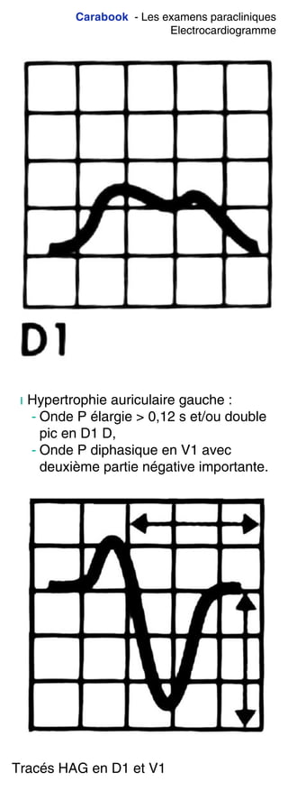 Carabook - Les examens paracliniques
Electrocardiogramme
ı Hypertrophie auriculaire gauche :
- Onde P élargie > 0,12 s et/ou double
pic en D1 D,
- Onde P diphasique en V1 avec
deuxième partie négative importante.
Tracés HAG en D1 et V1
 