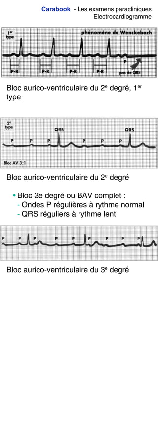 Carabook - Les examens paracliniques
Electrocardiogramme
Bloc aurico-ventriculaire du 2e
degré, 1er
type
Bloc aurico-ventriculaire du 2e
degré
• Bloc 3e degré ou BAV complet :
- Ondes P régulières à rythme normal
- QRS réguliers à rythme lent
Bloc aurico-ventriculaire du 3e
degré
 