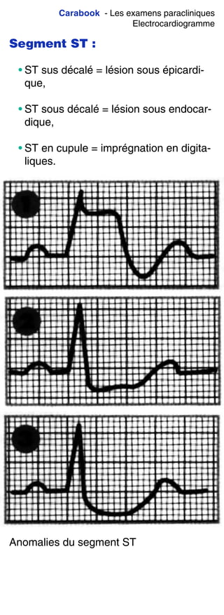 Carabook - Les examens paracliniques
Electrocardiogramme
Segment ST :
• ST sus décalé = lésion sous épicardi-
que,
• ST sous décalé = lésion sous endocar-
dique,
• ST en cupule = imprégnation en digita-
liques.
Anomalies du segment ST
 