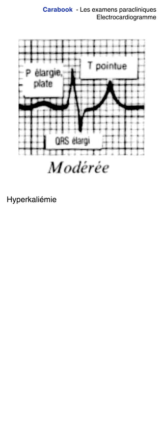 Carabook - Les examens paracliniques
Electrocardiogramme
Hyperkaliémie
 