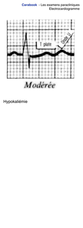 Carabook - Les examens paracliniques
Electrocardiogramme
Hypokaliémie
 