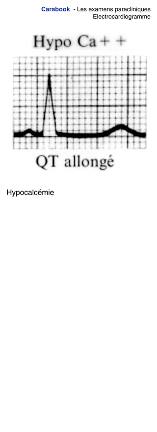 Carabook - Les examens paracliniques
Electrocardiogramme
Hypocalcémie
 