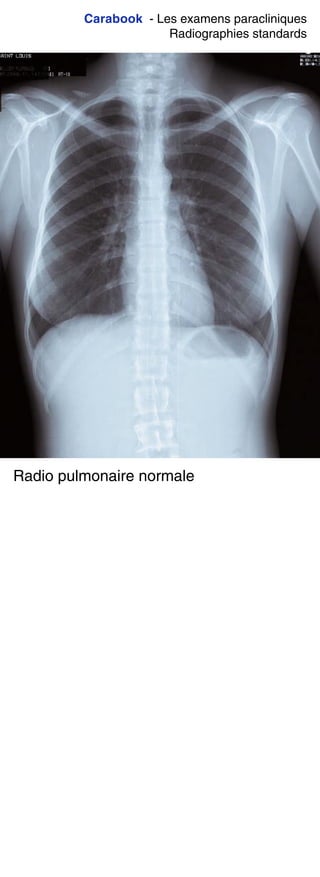 Carabook - Les examens paracliniques
Radiographies standards
Radio pulmonaire normale
 