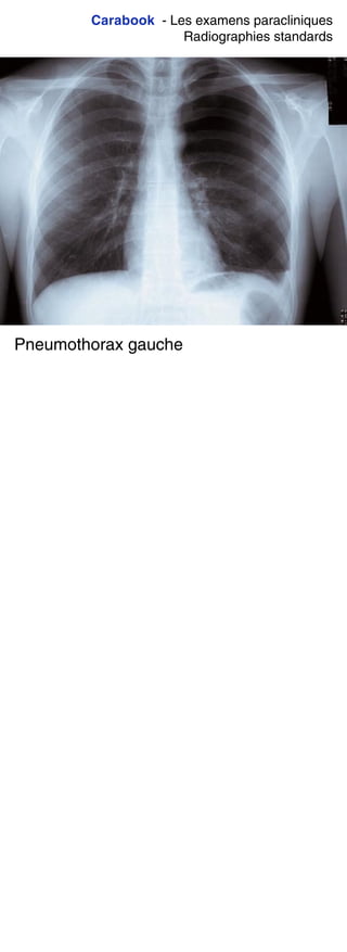 Carabook - Les examens paracliniques
Radiographies standards
Pneumothorax gauche
 